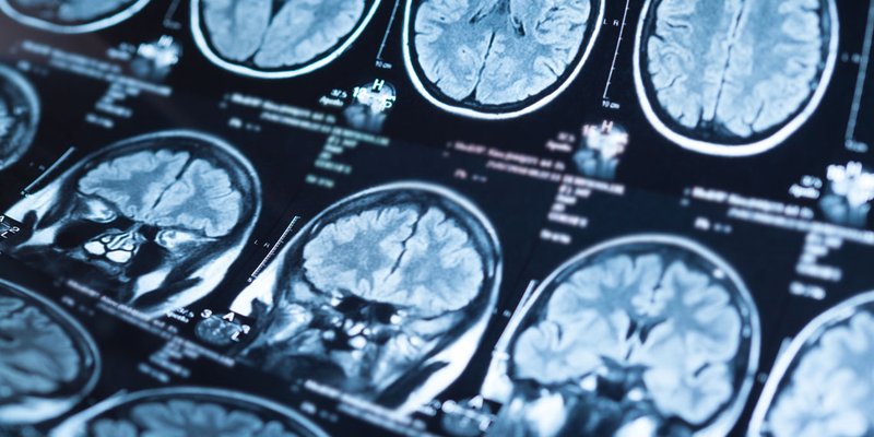 Differenze biologiche tra uomini e donne con PTSD